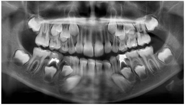 Рентгеновский снимок полости рта 