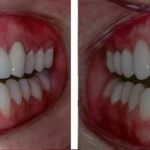Виниры на зубах до и после