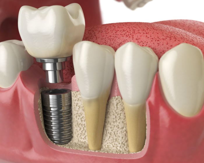 Товары для имплантации зубов бренда «Dentis»: где купить и как выбрать